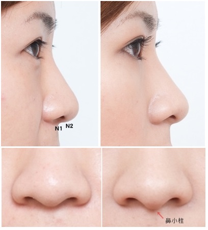 玻尿酸五點美鼻 下巴修飾 側臉