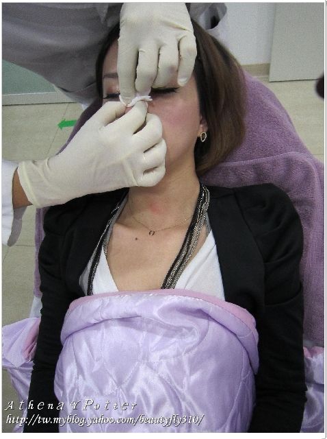 微晶瓷隆鼻過程08